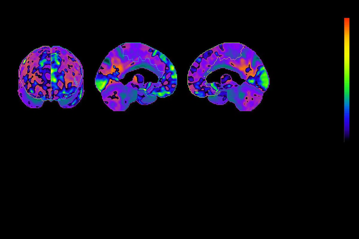 A colorful brain scan is pictured on a black background.
